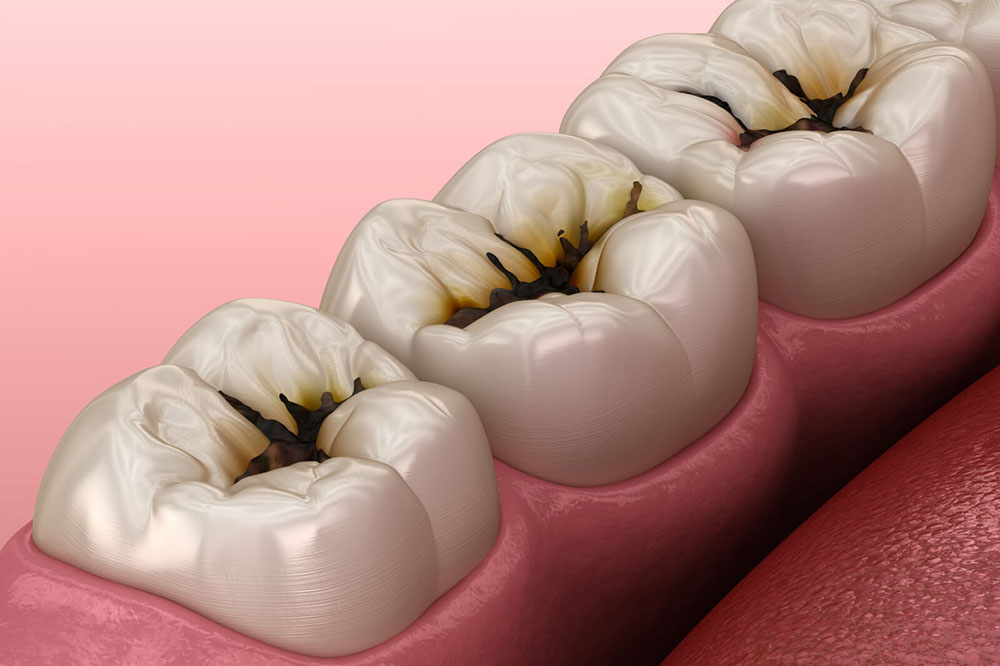 Често срещани зъбни проблеми - кариес